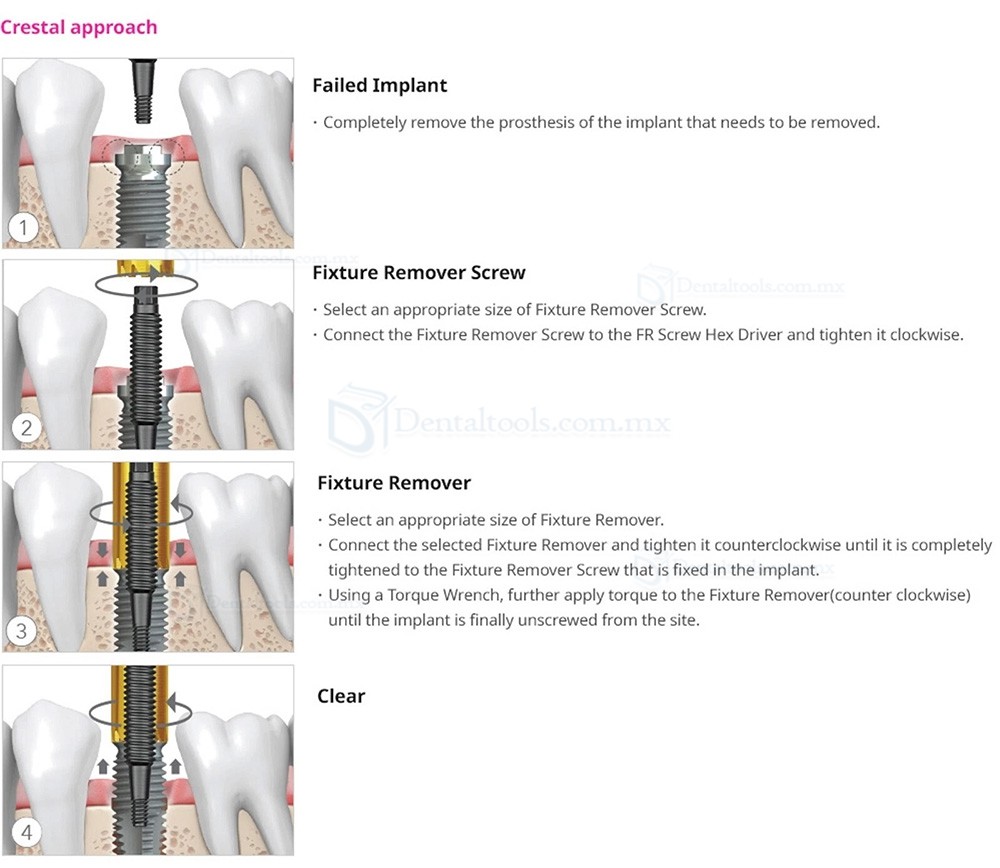 Kit de Remoci&oacute;n de Fijadores para Implantes Dentales con Llave de Torque